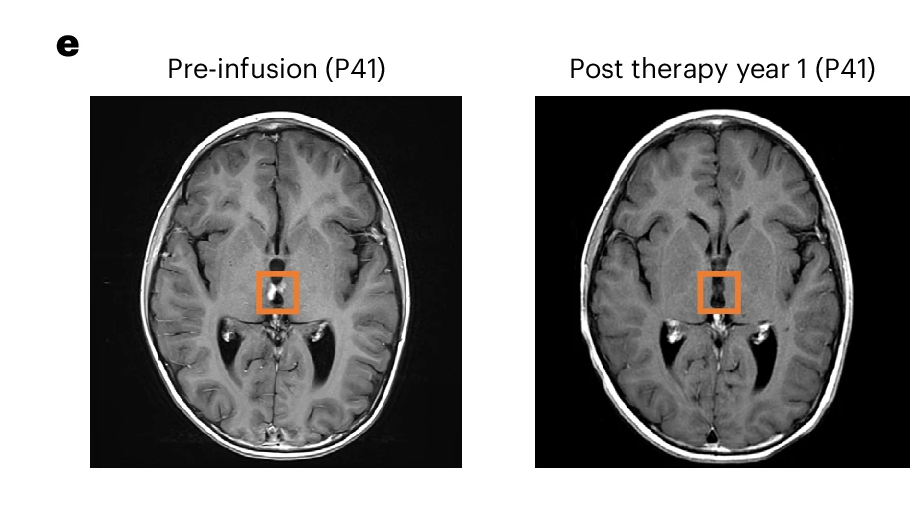 Two side-by-side post-contrast T1 MRI scans of P41's brain: before infusion on the left and one year after the final infusion on the right. An orange square marks the same deep-brain region in both scans; an enhancing lesion visible inside the square before infusion is absent at year 1.